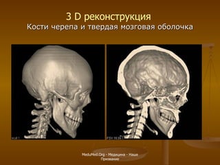 3  D  реконструкция  Кости черепа и твердая мозговая оболочка MeduMed.Org -  Медицина - Наше Призвание 