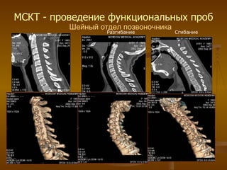 МСКТ - проведение функциональных проб Шейный отдел позвоночника Разгибание Сгибание 