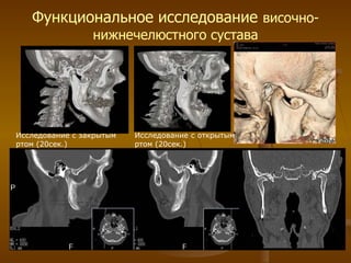 Функциональное исследование   височно-нижнечелюстного сустава Исследование с открытым ртом (20сек.) Исследование с закрытым ртом (20сек.) 