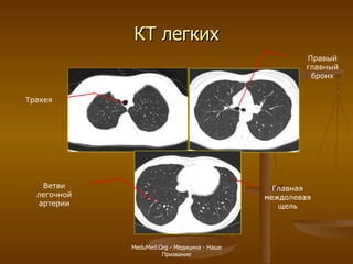 КТ легких Трахея Правый главный бронх Главная междолевая щель Ветви легочной артерии MeduMed.Org -  Медицина - Наше Призвание 
