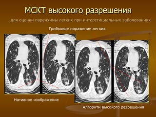 МСКТ высокого разрешения Нативное изображение Алгоритм высокого разрешения для оценки паренхимы легких при интерстициальных заболеваниях Грибковое поражение легких 