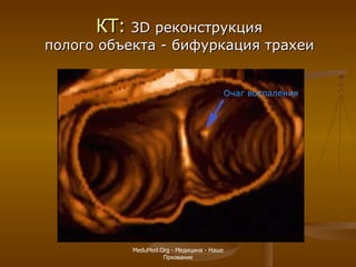 КТ:   3 D  реконструкция полого объекта - бифуркация трахеи Очаг воспаления MeduMed.Org -  Медицина - Наше Призвание 