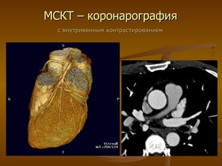 МСКТ – коронарография с внутривенным контрастированием 