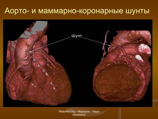 Шунт Аорто- и маммарно-коронарные шунты MeduMed.Org -  Медицина - Наше Призвание 