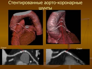 Стентированные аорто-коронарные шунты Стент Стент 