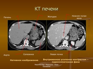 КТ печени Нативное изображение Внутривенное усиление контрастом – паренхиматозная фаза Печень Селезенка Желудок Аорта Нижняя полая вена Левая почка MeduMed.Org -  Медицина - Наше Призвание 