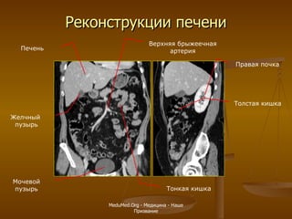 Реконструкции печени Печень Желчный  пузырь Мочевой пузырь Правая почка Толстая кишка Тонкая кишка Верхняя брыжеечная артерия MeduMed.Org -  Медицина - Наше Призвание 