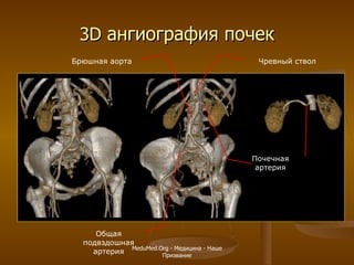 3 D  ангиография почек Общая подвздошная артерия Брюшная аорта Почечная артерия Чревный ствол MeduMed.Org -  Медицина - Наше Призвание 