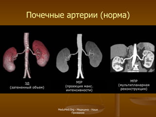 Почечные артерии (норма) 3Д (затененный объем) MIP (проекция макс. интенсивности) МПР (мультипланарная реконструкция) MeduMed.Org -  Медицина - Наше Призвание 