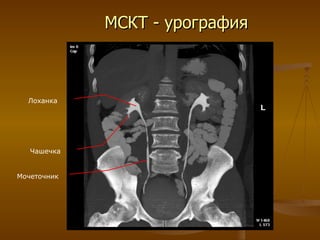 МСКТ - урография Чашечка Лоханка Мочеточник 