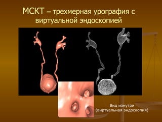 МСКТ   –  трехмерная   урография с виртуальной эндоскопией Вид изнутри (виртуальная эндоскопия) 