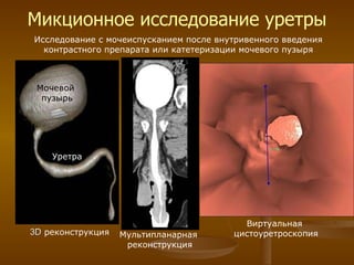 Микционное исследование уретры Исследование с мочеиспусканием после внутривенного введения контрастного препарата или катетеризации мочевого пузыря 3 D  реконструкция Мультипланарная  реконструкция Виртуальная  цистоуретроскопия Мочевой  пузырь Уретра 