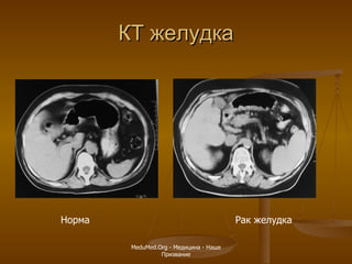 КТ желудка Норма  Рак желудка MeduMed.Org -  Медицина - Наше Призвание 