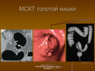 МСКТ толстой кишки MeduMed.Org -  Медицина - Наше Призвание 
