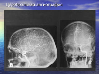 Церебральная ангиография 