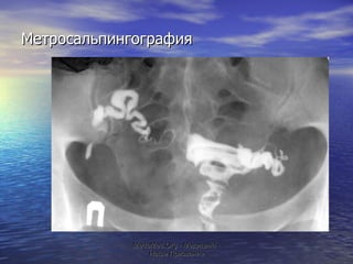 Метросальпингография MeduMed.Org -  Медицина - Наше Призвание 