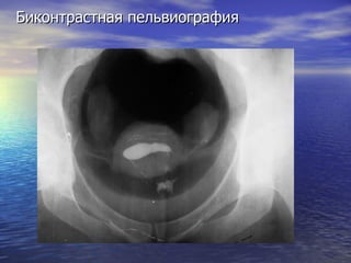 Биконтрастная пельвиография 
