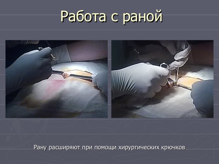 Лапароцентез