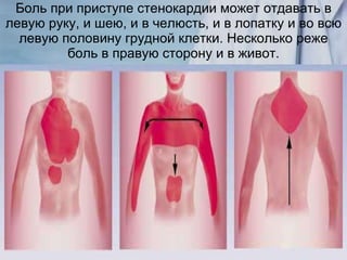 Боль при приступе стенокардии может отдавать в левую руку, и шею, и в челюсть, и в лопатку и во всю левую половину грудной клетки. Несколько реже боль в правую сторону и в живот. 