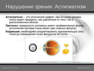 Нарушение зрения: Астигматизм Астигматизм  –  это оптический дефект, при котором человек плохо видит предметы, как удаленные от него, так и расположенные вблизи. Причины:  поверхность роговицы имеет несферическую форму (оптическая система глаза имеет два главных фокуса). Коррекция:  необходимо скорректировать преломляющую силу глаза до совмещения точек фокуса на сетчатке. (Офтальмологический центр Коновалова  www.konovalov-eye-center.ru ,  клиника Эксимер  www.excimerclinic.ru ) Органы чувств: Глаз     МЫСКОВА Ольга 