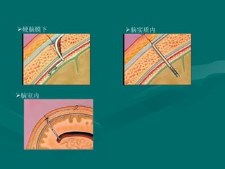 硬脑膜下 脑室内 脑实质内 