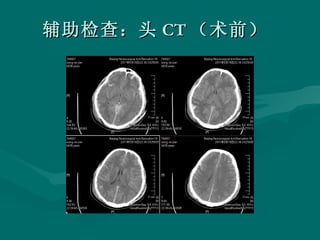 辅助检查：头 CT （术前）  