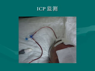 ICP 监测 