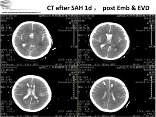 CT after SAH 1d ， post Emb & EVD CHINA International Neuroscience Institute ICU 