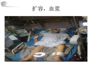 扩容，血浆 