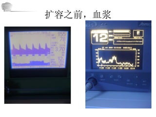扩容之前，血浆 