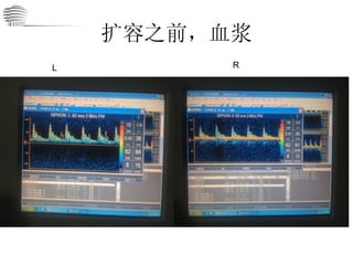 扩容之前，血浆 L R 