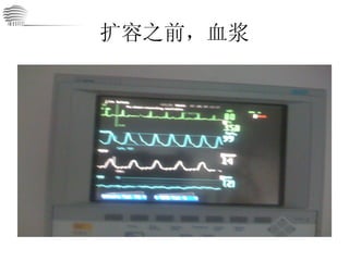 扩容之前，血浆 