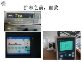 扩容之前，血浆 