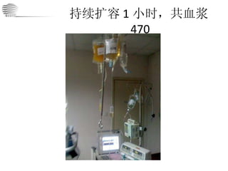 持续扩容 1 小时，共血浆 470 