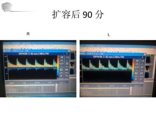 扩容后 90 分 R L 