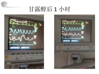 甘露醇后 1 小时 