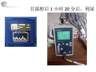 甘露醇后 1 小时 20 分后，利尿 