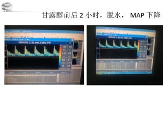 甘露醇前后 2 小时，脱水， MAP 下降 