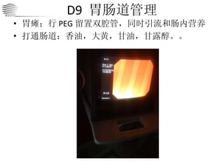 D9  胃肠道管理 胃瘫；行 PEG 留置双腔管，同时引流和肠内营养 打通肠道：香油，大黄，甘油，甘露醇。。 