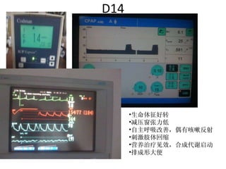 D14 生命体征好转 减压窗张力低 自主呼吸改善，偶有咳嗽反射 刺激肢体回缩 营养治疗见效，合成代谢启动 排成形大便 