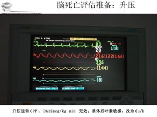 脑死亡评估准备：升压 CHINA International Neuroscience Institute ICU 升压逆转 CPP ； DA12mcg/kg.min  无效；垂体后叶素敏感，改为 6u/h 