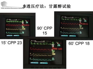 渗透压疗法：甘露醇试验 15’ CPP 23 60’ CPP 18 90’ CPP 15 CHINA International Neuroscience Institute ICU 