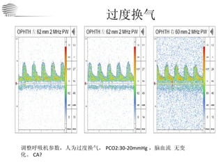 过度换气 调整呼吸机参数，人为过度换气， PCO2:30-20mmHg ，脑血流 无变化。 CA? 