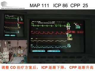 MAP 111  ICP 86  CPP  25 CHINA International Neuroscience Institute ICU 调整 CO 治疗方案后， ICP 逐渐下降， CPP 逐渐升高 