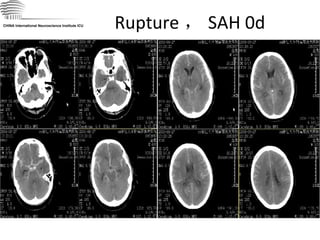Rupture ， SAH 0d CHINA International Neuroscience Institute ICU 