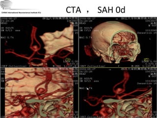 CTA  ， SAH 0d CHINA International Neuroscience Institute ICU 