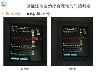 脑灌注滴定治疗合理性的间接判断 压力指标：   ICP↓ 和 CPP↑ 治疗前 治疗后 CHINA International Neuroscience Institute ICU 