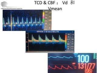 TCD & CBF ： Vd  和 Vmean CHINA International Neuroscience Institute ICU 
