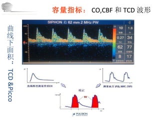 容量指标 ： CO,CBF 和 TCD 波形 CHINA International Neuroscience Institute ICU 曲线下面积： TCD &Picco 