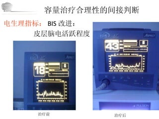 容量治疗合理性的间接判断 电生理指标： BIS 改进： 皮层脑电活跃程度 治疗前 治疗后 CHINA International Neuroscience Institute ICU 